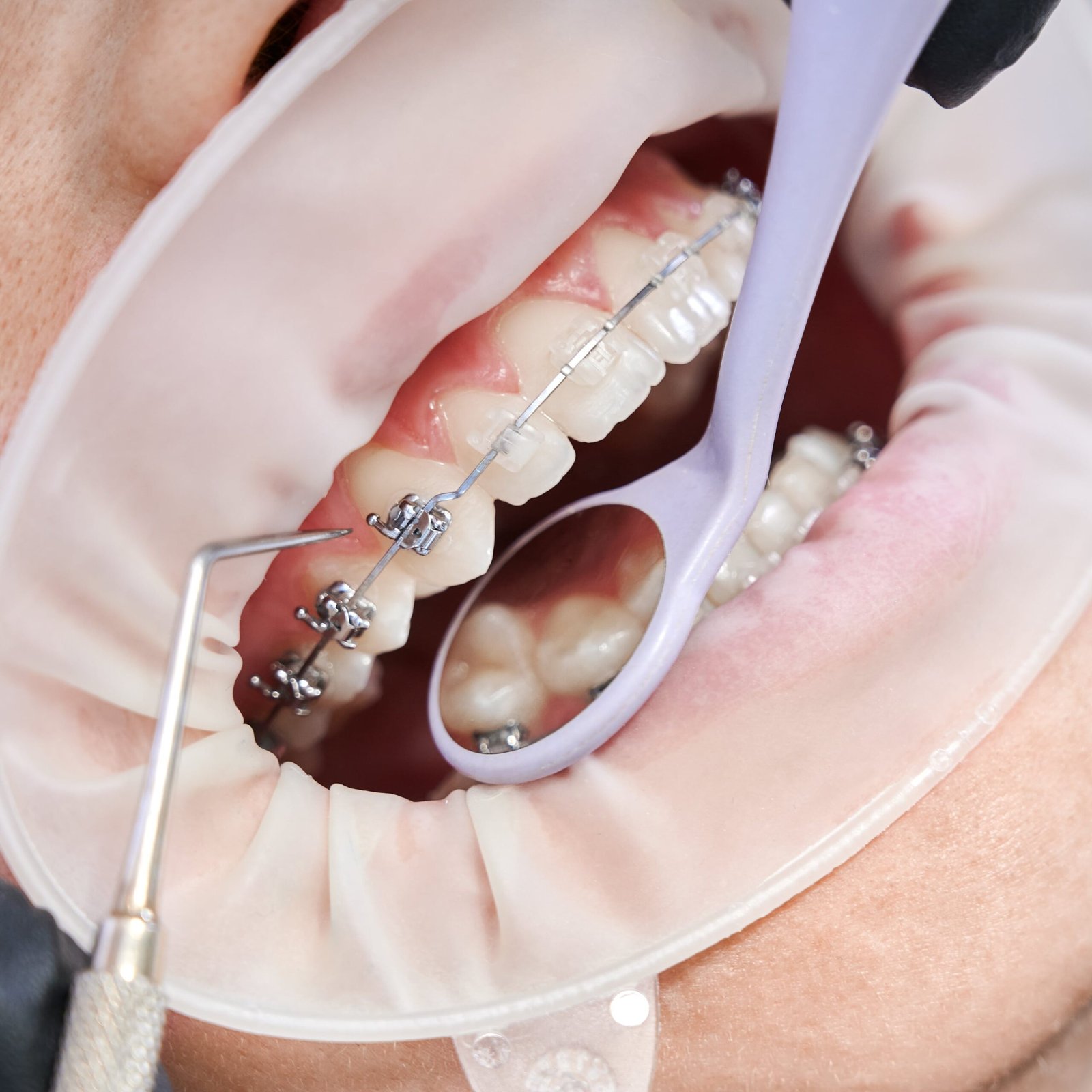 dentist-attaching-metal-braces-patient-teeth-min